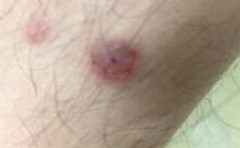 男性二期梅毒的症状