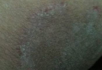 男性梅毒的检查措施是啥