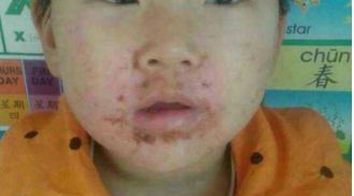 寻常性脓疱疮都表现有啥
