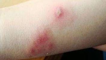 新生儿患脓疱疮该怎么办