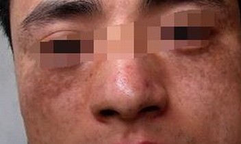色斑患者需注意些什么