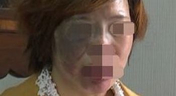 治疗太田痣的措施什么 呢 