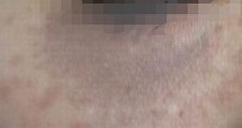咨询太田痣用激光会有并发症吗