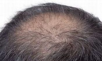 脂溢性脱发的治疗是怎样进行 