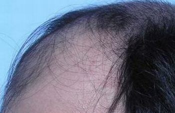 脂溢性脱发怎样预防