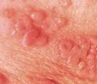 大家明了生殖器疱疹的症状吗