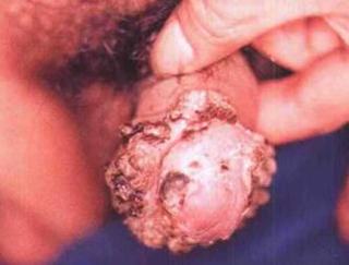 复发性生殖器疱疹的早期的症状