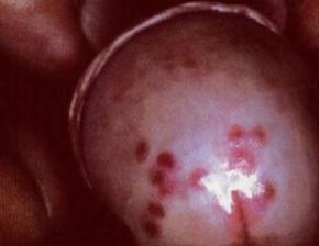生殖器疱疹的致病因素