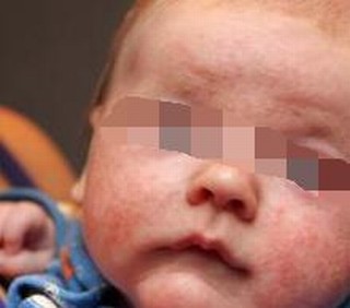 如何对抗婴儿湿疹