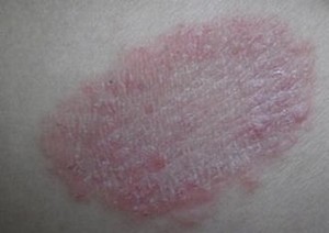 股癣治疗小偏方