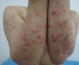 男生如何避免股癣