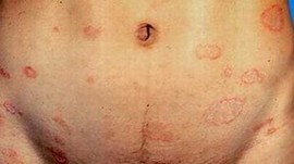 女性体股癣病患要留意那些