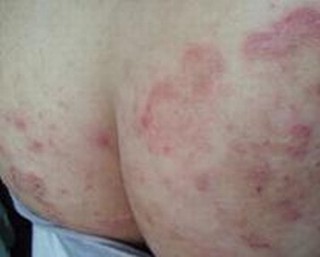 如此做就能够远离体股癣