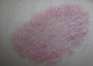 体癣患者的饮食护理是啥