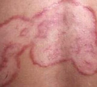 体癣患者不错怎样进行治理