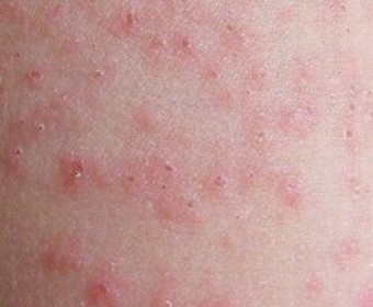 胆碱性荨麻疹病因