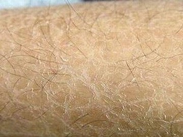 鱼鳞病患者不宜做的几件事