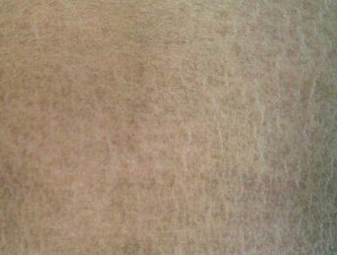 鱼鳞病患者护理有什么要求