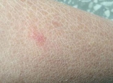 鱼鳞病患者吃那些食物较好
