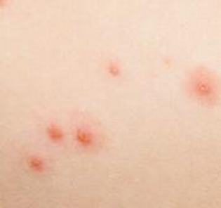 带状疱疹初期会表现出什么症状