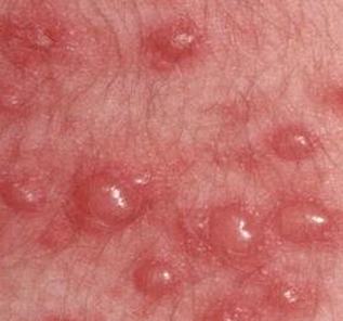 带状疱疹的初期表现都包含什么带状疱疹
