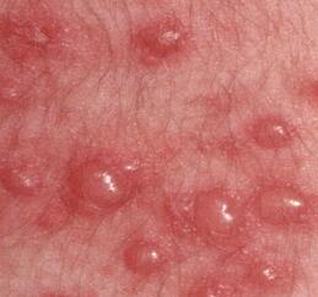 带状疱疹的发病症状有哪些