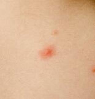病毒性带状疱疹是啥带状疱疹