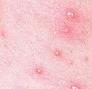 带状疱疹的类型有哪些呢带状疱疹