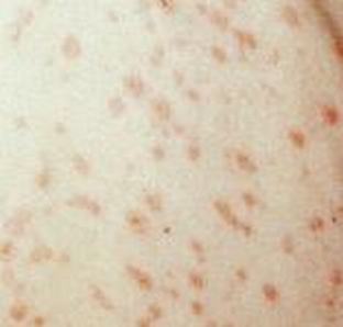 带状疱疹并发哪些疾病