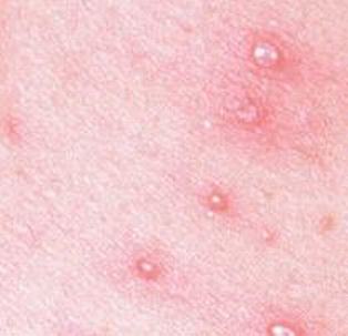 带状疱疹产生的病因有什么