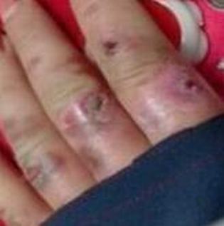冻疮的发病机制是啥 