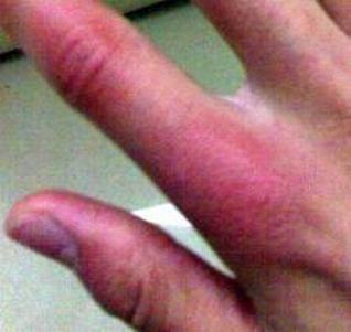 冻疮的体现都有啥呢