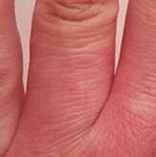 冻疮的致病因素