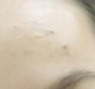 痘印如何除掉 