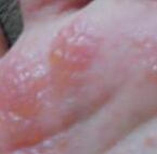 汗疱疹的特点