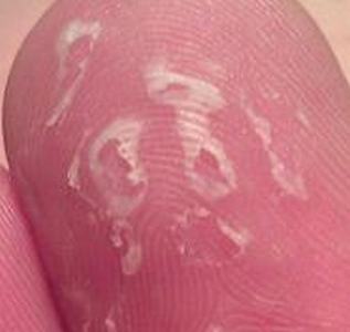 汗疱疹和手癣的症状区别有什么