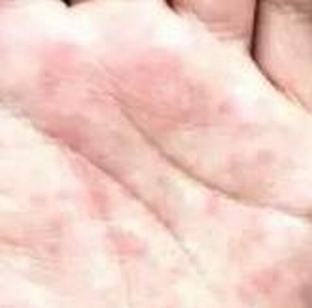 汗疱疹的导致病因有什么