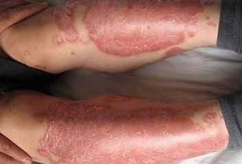 男性牛皮癣会形成什么危害