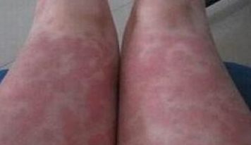 哪些人们易患顽固性牛皮癣