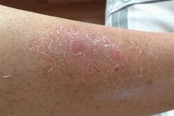 牛皮癣的初期病情是啥