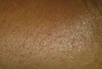 皮肤异痒症如何治疗