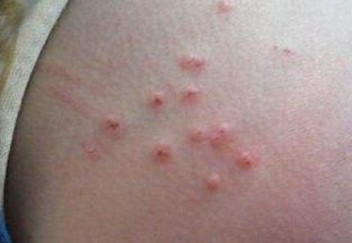 皮肤异痒是哪些疾病的先兆