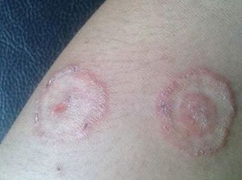 生活中预防体癣的要点