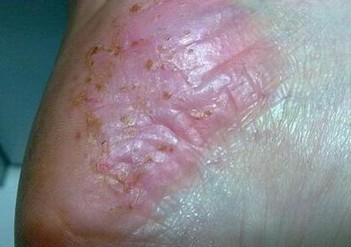 脚气给患者捎来的伤害有什么