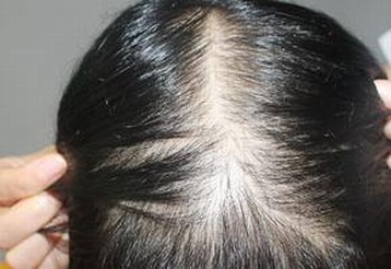 女性脱发怎样做