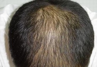 夏季女人为何这么简单脱发