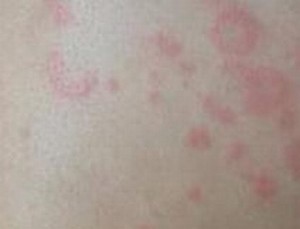 儿童荨麻疹有哪些病因
