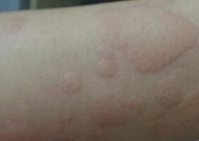 不一样类型荨麻疹的多见症状