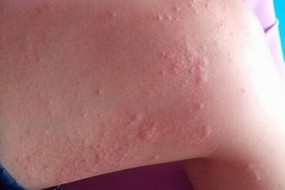 人工荨麻疹的症状特征