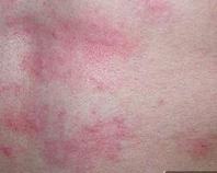 丘疹性荨麻疹详细得症状
